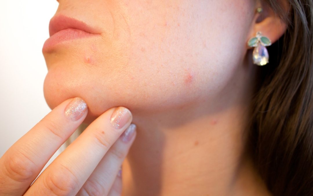Se débarrasser naturellement de l’acné