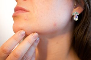 Lire la suite à propos de l’article Se débarrasser naturellement de l’acné