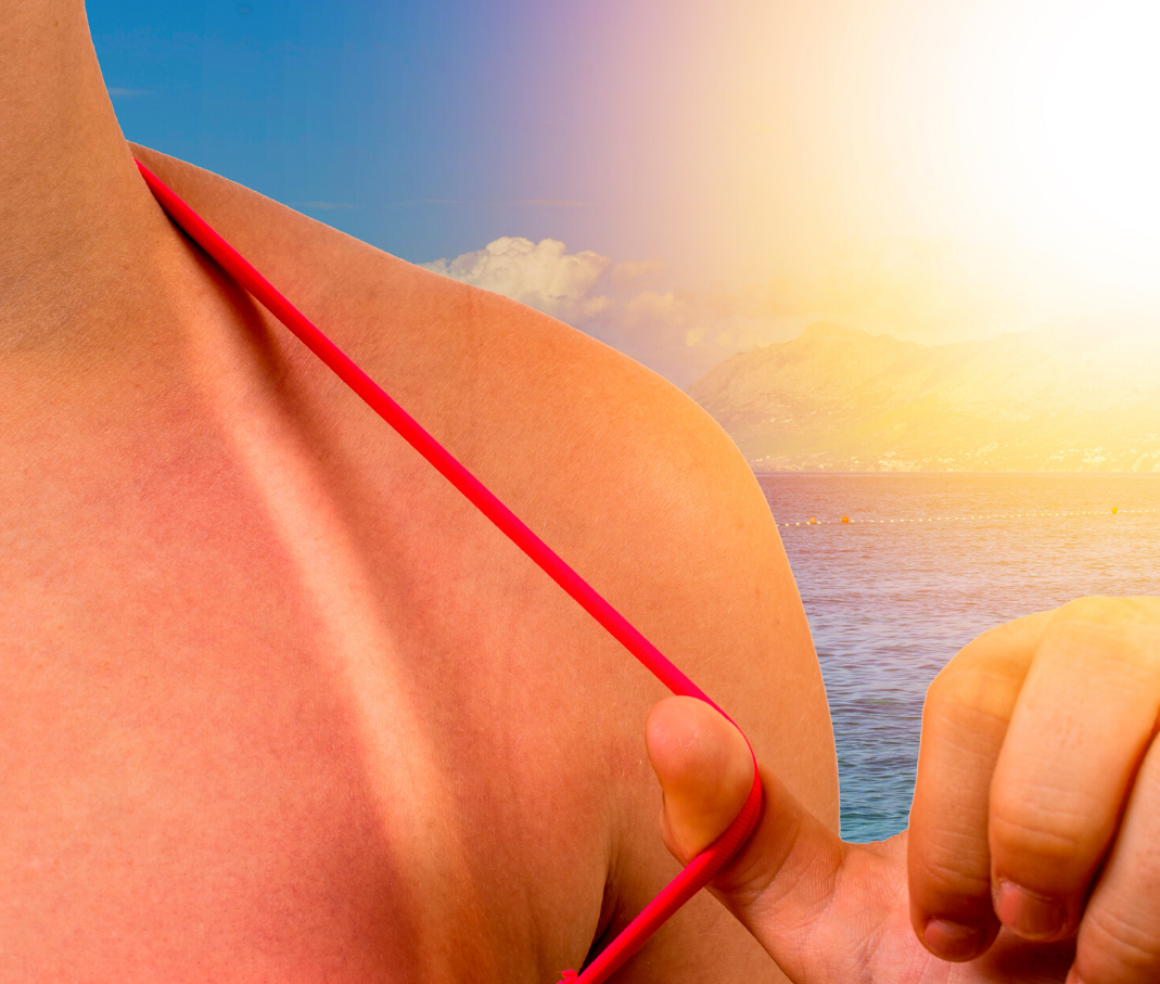 coups-de-soleil-huile-essentielle-latifa-naturo.fr